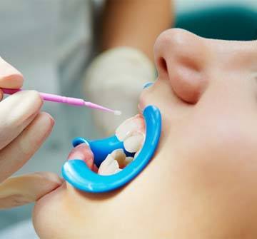 Pediatric dentist in Nashua applying dental sealants