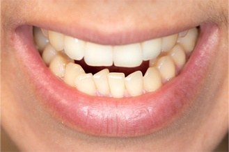 Closeup of crowded teeth before Invisalign in Nashua