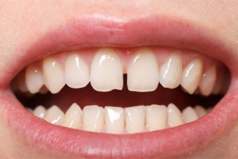 Closeup of gapped teeth before Invisalign in Nashua