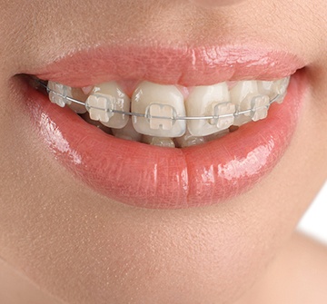 Closeup of smile with clear and ceramic braces