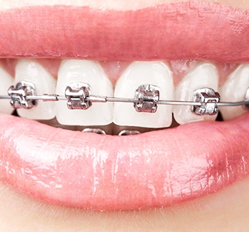 Closeup of smile with damon braces