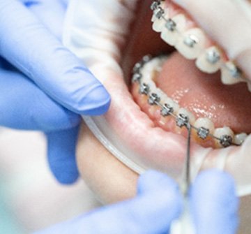 Nashua orthodontist placing braces on teeth