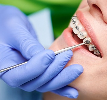 Closeup of orthodontist fixing patient's braces