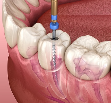 Animated smile during root canal or pulp therapy
