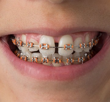 Closeup of child smiling with traditional orthodontics in Nashua