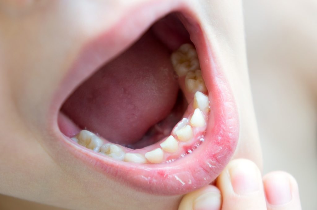 Closeup of child with shark teeth