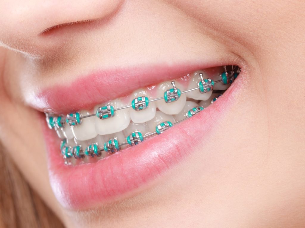 Closeup of patient smiling with traditional braces