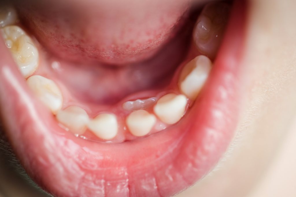 Closeup of child with shark teeth