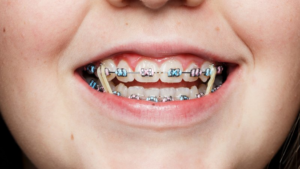 a patient with braces and rubber bands